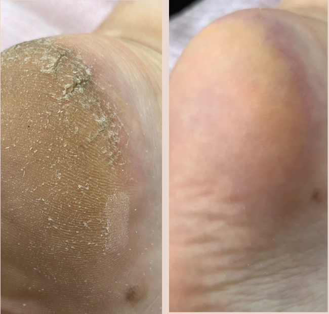 Avant-après de soin des pieds à l'institut de beauté à Alfortville, montrant des talons visiblement restaurés et lisses.