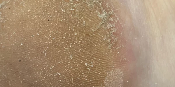 Talons avant les soins ONA à l'institut de beauté d'Alfortville, promouvant la régénération de la peau pour un bien-être optimal.