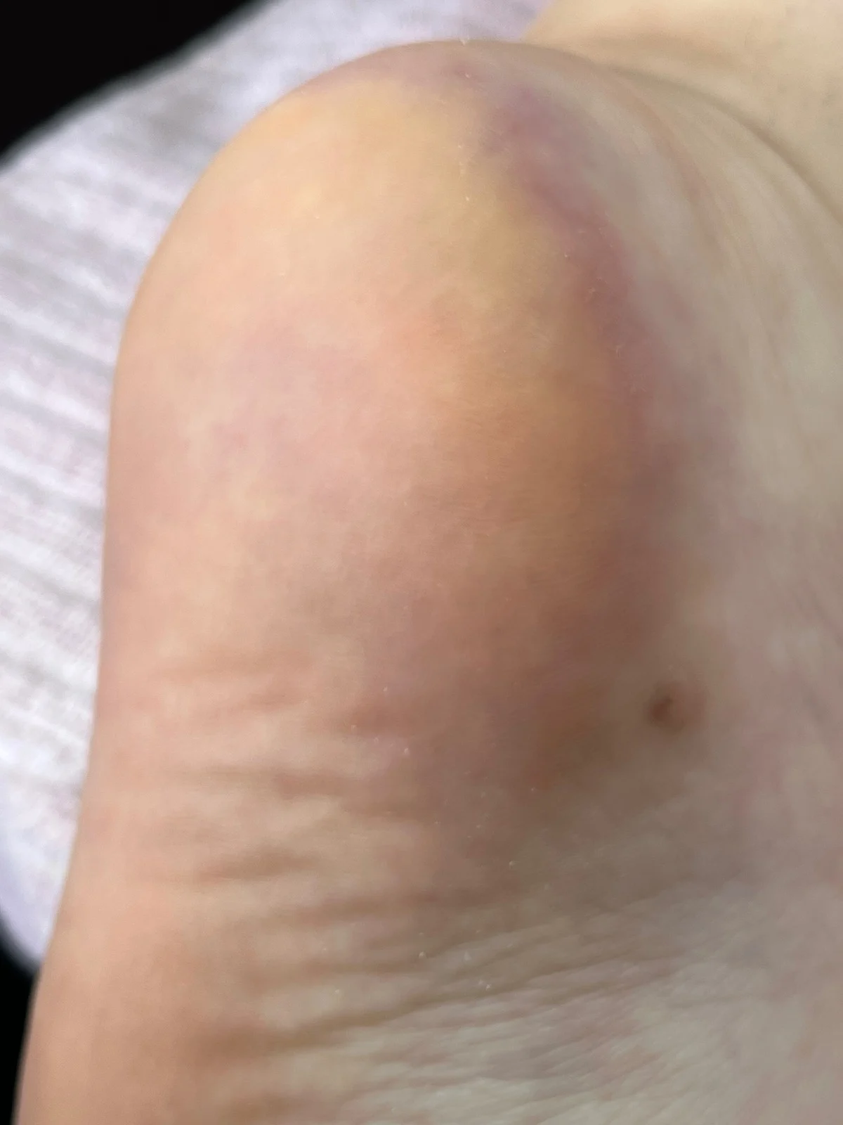 Heel recovering from bruise cared for with professional skin treatment at institut de beauté Le Bel Ongle, Alfortville.